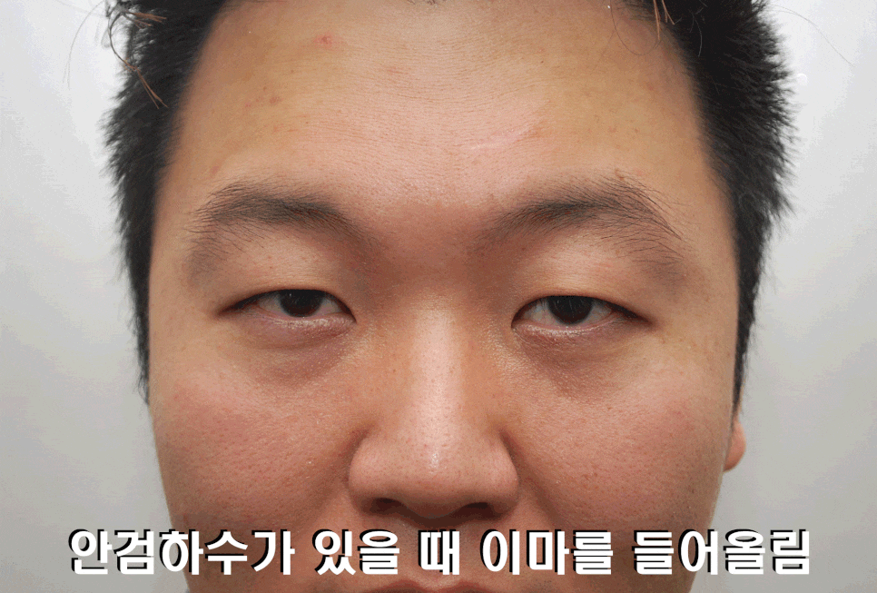 안검하수 수술 후에 쌍꺼풀이 꼭 생기나요? 관련 이미지 4