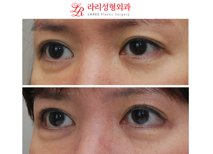 앞트임재수술,눈꼬리가 많이 올라가지 않은 경우의 눈꼬리내리기뒤트임재수술 관련 이미지 3