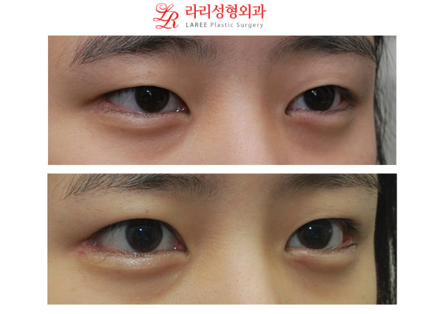 No-line monolid eye correction, downturned outer corner epicanthoplasty revision before-and-after photos image 2