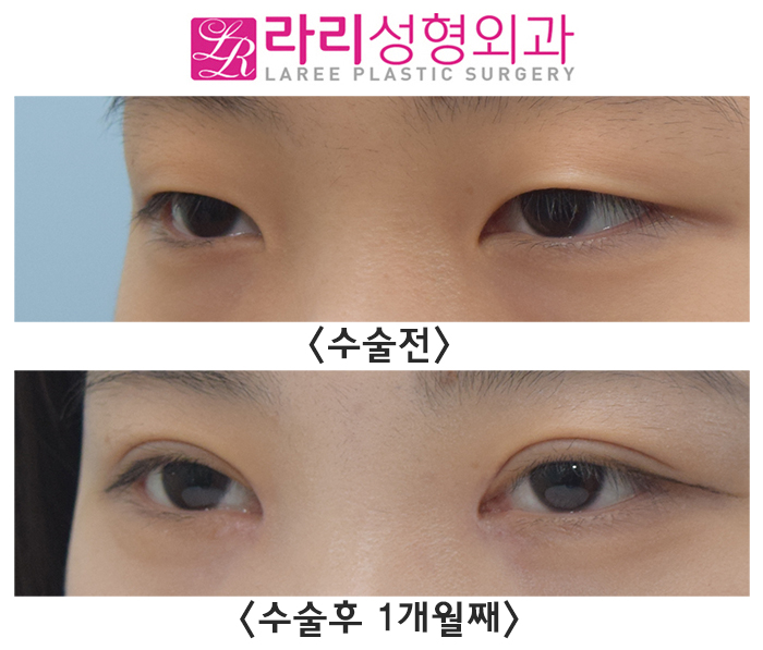 [라리성형외과] 쌍꺼풀 만드는 절개눈매교정과 앞트임수술 전후 관련 이미지 3