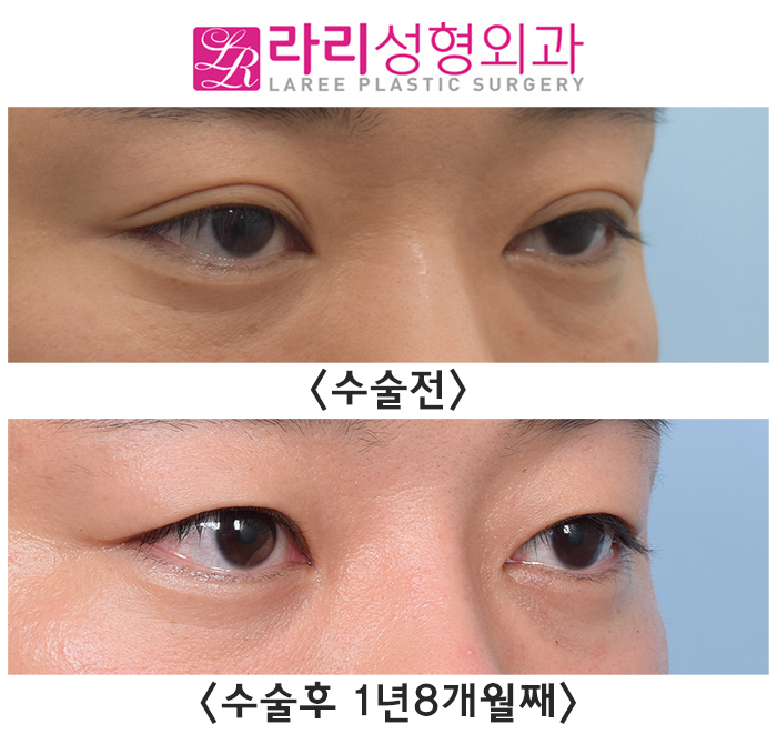 [Rari Plastic Surgery] Before and after surgery: removing a poorly lifting natural double eyelid to transform into a handsome-looking eye image 1