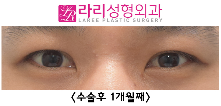 [Lari Plastic Surgery] See the Process of Correcting Uneven Eyes After Double Eyelid Removal Surgery image 3