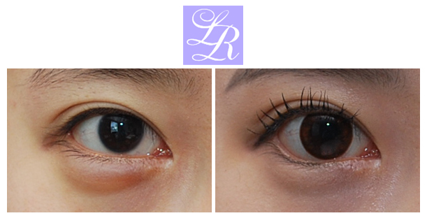 If You Want an S-Line Under Your Eyes, Try Lower Eye Widening image 1