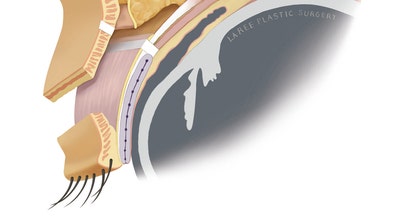 [라리성형외과] 무절제 겉쌍꺼풀없애기 무쌍수술 전후 (+절개와 절제의 차이) 관련 이미지 5