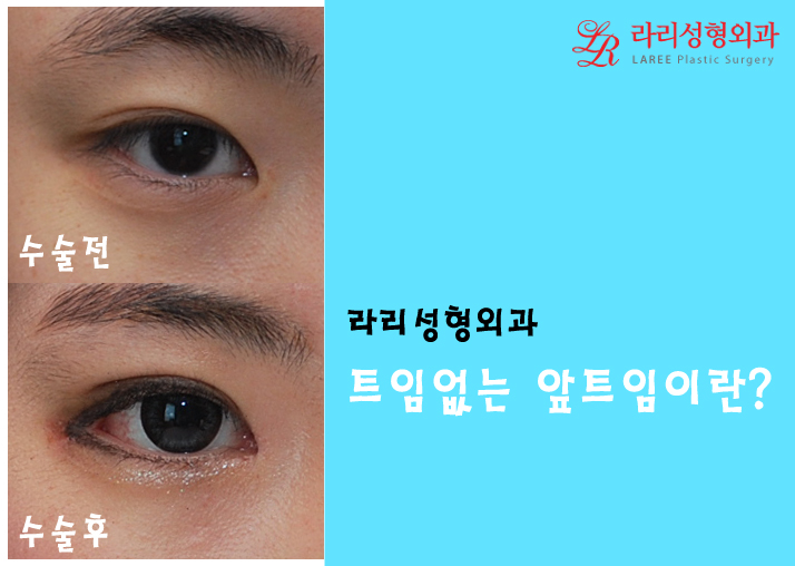 몽고주름, 더이상 헤매지말고 트임없는앞트임으로! 관련 이미지 4