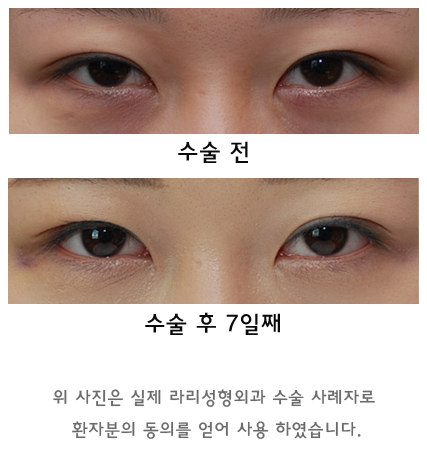 Swelling and Results Judged from Photos in Non-Incision Eye Correction Reviews image 10