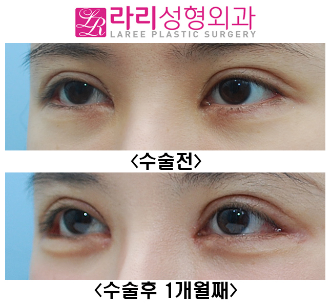 [라리성형외과] 눈매교정재수술 짝눈교정 뒤트임재수술 눈꼬리내리기 관련 이미지 3