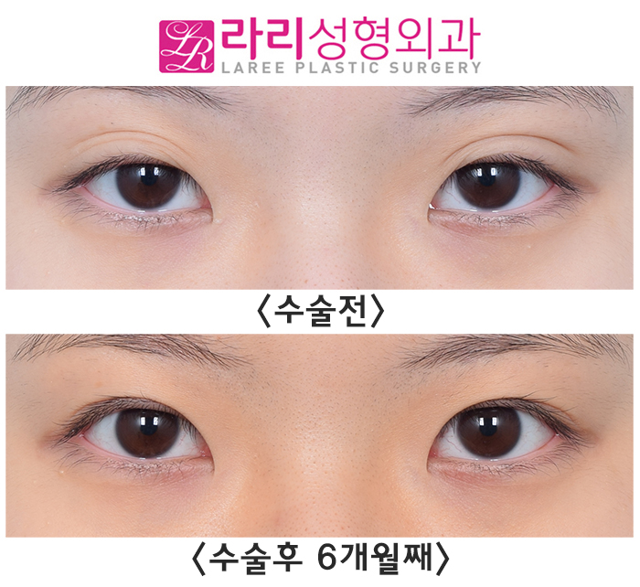 [라리성형외과] 매몰 쌍수가 풀리면 쌍꺼풀 재수술? NoNo 쌍꺼풀 없애기! 관련 이미지 3