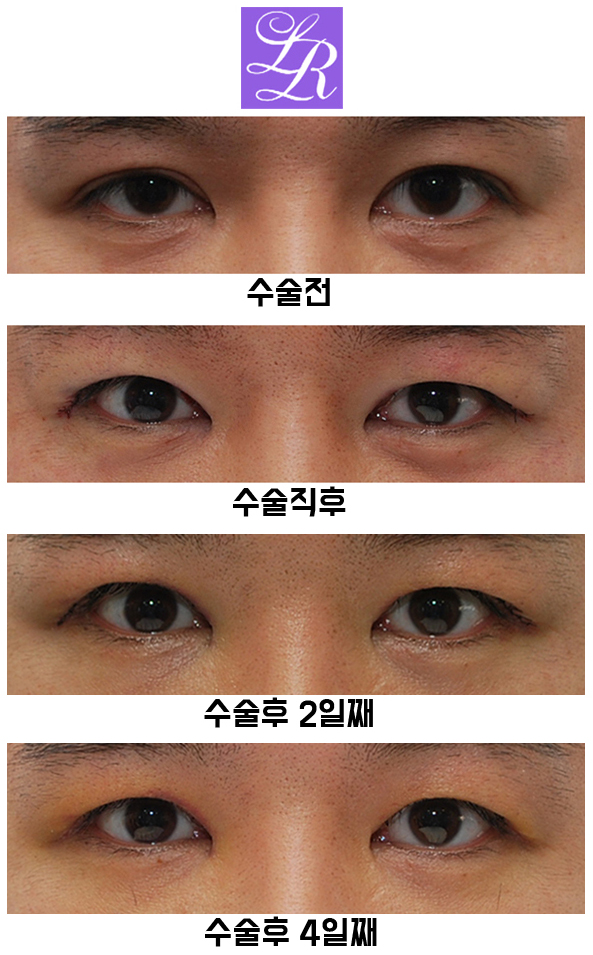 Review of Double Eyelid Reversal Surgery - Day 4 After Surgery, Swelling After Double Eyelid Surgery image 3