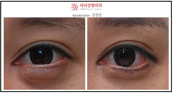 밑트임,바비밑트임,눈밑트임 전후사진 관련 이미지 1