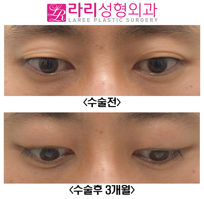 [라리성형외과] 쌍꺼풀없애기와 함께 한 윗눈꺼풀 패임 교정, 눈두덩이(Roof) 지방이식수술 전후사진 관련 이미지 6