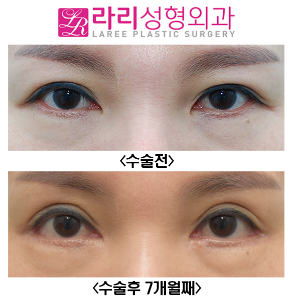 [라리성형외과] 쌍꺼풀재수술로 쌍수라인 높이기와 눈꼬리내리기뒤트임 관련 이미지 1
