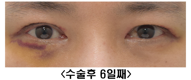 [라리성형외과] 쌍꺼풀없애기 수술 후 짝짝이, 괜찮아질까? 관련 이미지 3