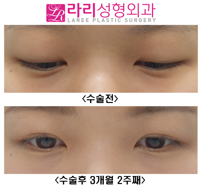 [라리성형외과] 여자도 무쌍눈매교정이 어울릴까? 관련 이미지 3