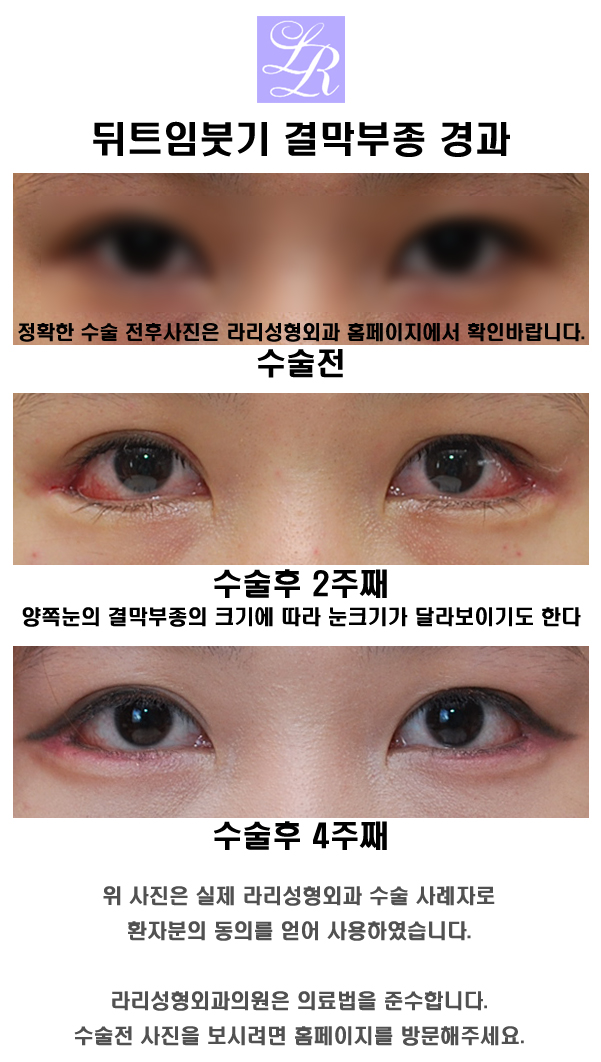 Is Swelling After Lateral Canthoplasty, Conjunctival Edema, a Side Effect? image 1