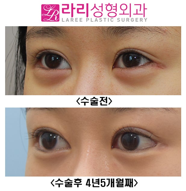 [라리성형외과] 눈이 확 커지는 눈꼬리내리기뒤트임을 원한다면 장기 경과 수술 전후 사진을 함께 봐야 합니다. 관련 이미지 4