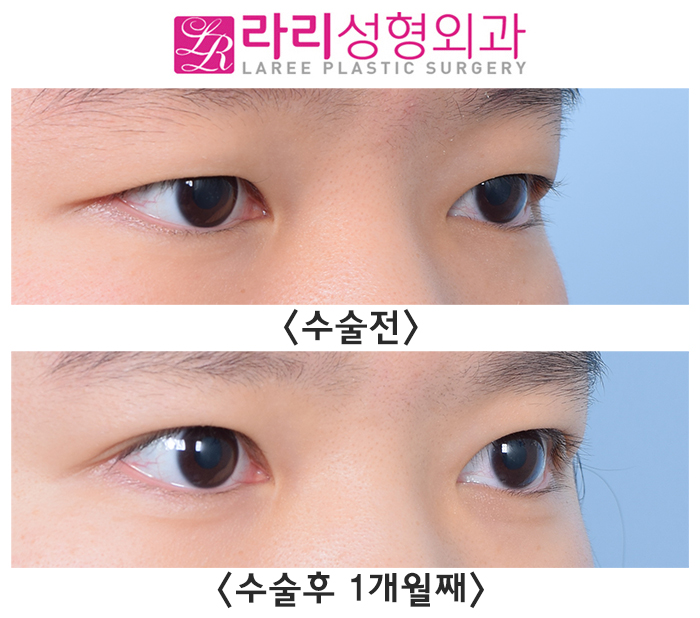 [라리성형외과] 비절개눈매교정 한 달 차 - 피부 절제 없이, 간단하고 또렷하게 관련 이미지 3