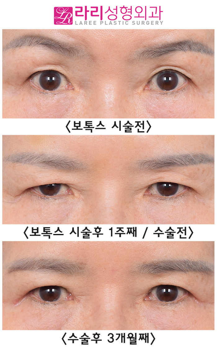 [Rari Plastic Surgery] Why You Should Get Forehead Botox Before Upper Blepharoplasty, as Seen in Before-and-After Photos image 6