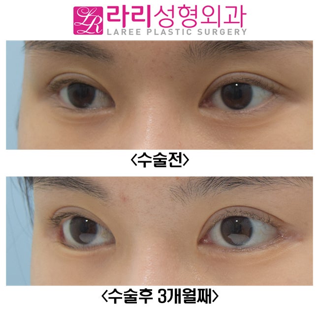 [라리성형외과] 효과 확실한 눈꼬리내리기뒤트임수술 단기 경과 전후 사진 관련 이미지 2
