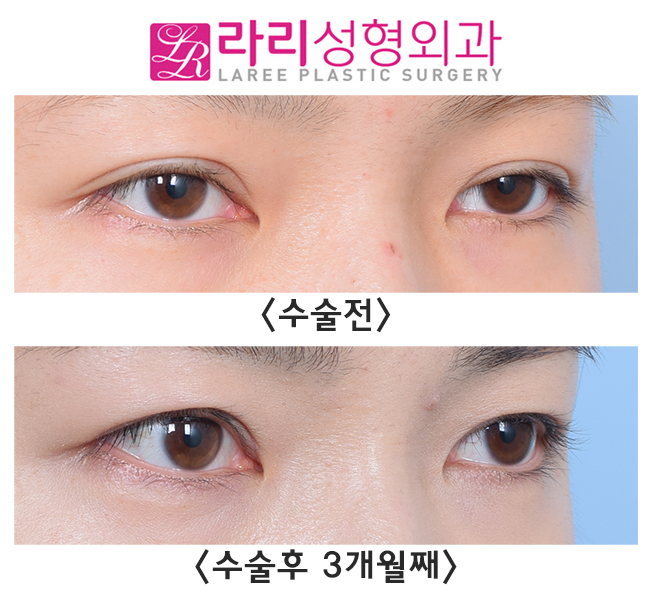 [라리성형외과] 쌍꺼풀재수술 라인낮추기 회복 기간 필수! 관련 이미지 5