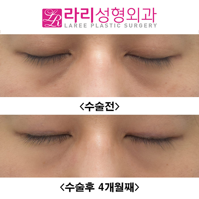 [라리성형외과] 눈이 작아지지 않으면서 쌍꺼풀없애는수술 전후사진 관련 이미지 2