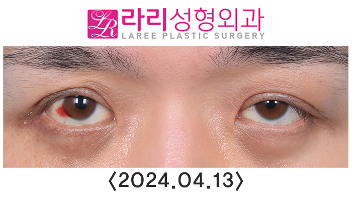 [Lari Plastic Surgery] Double Eyelid Removal Surgery and Upper Eyelid Fat Grafting Surgery: Comparing Recovery and Swelling Over 6 Months image 2