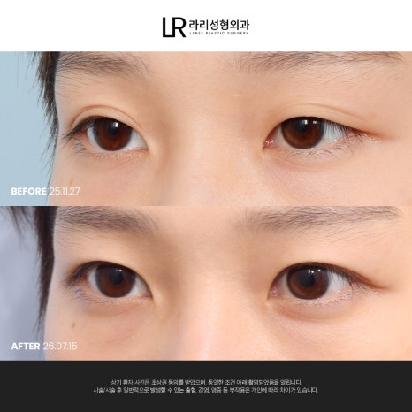 [라리성형외과] 쌍꺼풀수술 전후 사진으로 보는 눈매교정의 중요성 관련 이미지 4
