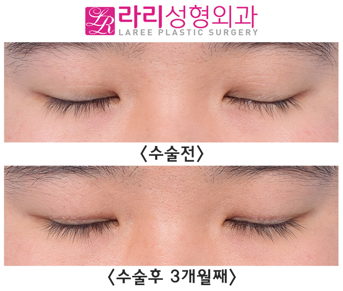 [라리성형외과] 쌍꺼풀 있어도 흐리멍텅한 눈 vs 쌍꺼풀 없어도 똘망똘망한 눈 관련 이미지 3