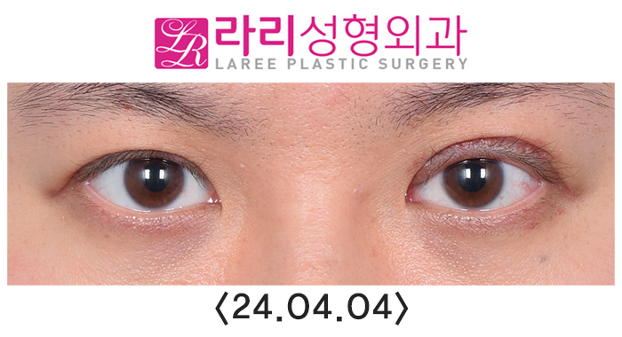 [라리성형외과] 쌍꺼풀없애는수술 후 필요에 의한 재교정과 회복 과정 기간별 사진 관련 이미지 4