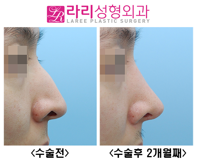 [Lari Plastic Surgery] Hump Nose Surgery Without an Implant image 3