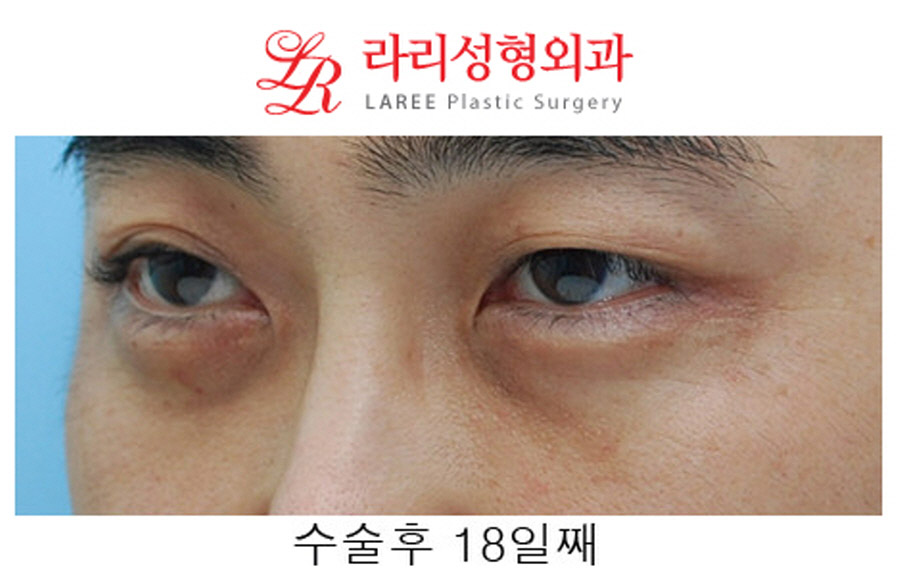 Under-Eye Fat Repositioning Before and After in Your 40s image 8