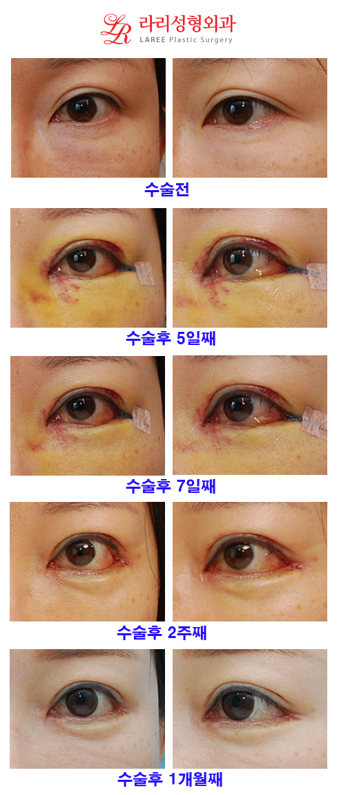 Revision Double Eyelid Surgery (Sausage Correction), Epicanthoplasty, Canthoplasty, Under-Eye Fat Removal, and Aegyo-Sal Fat Grafting image 1