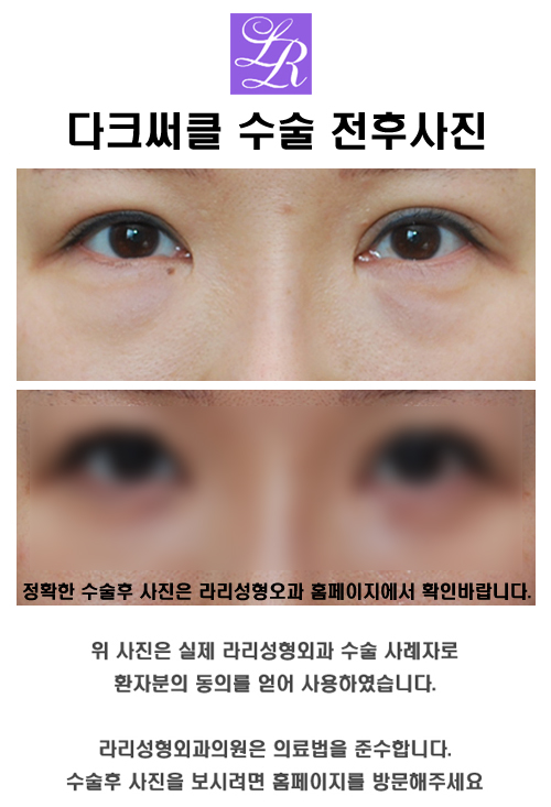 눈수술종류 뭐가 있나요? 관련 이미지 9