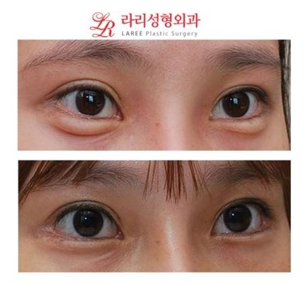 눈꼬리내리기뒤트임/뒷트임 재수술 전후사진 관련 이미지 2