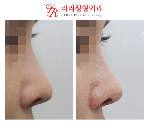 Before and After Photos of Revision Tip Rhinoplasty for a Collapsed Nasal Tip image 1