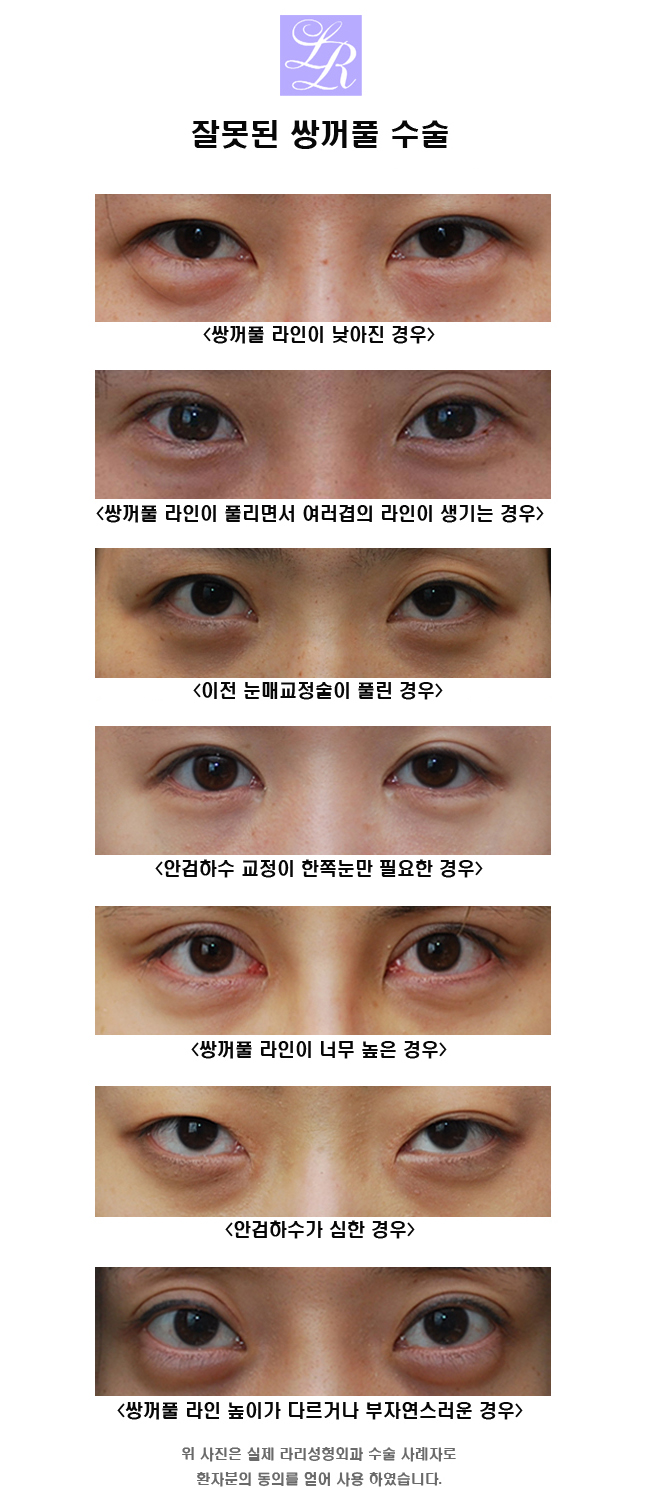 쌍커플 재수술 잘하는 병원 찾아가기 관련 이미지 1