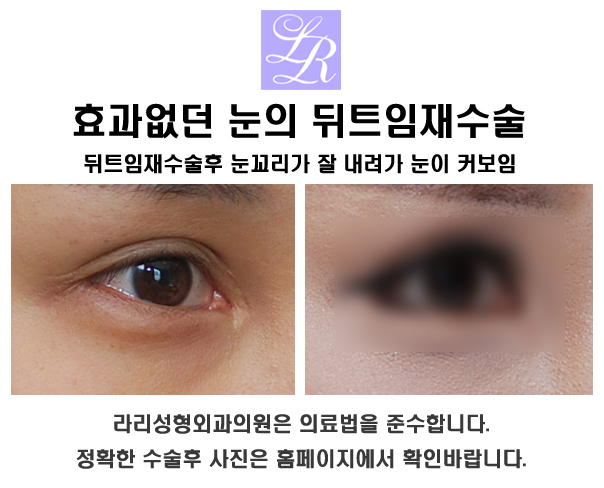 Revision of Lateral Canthoplasty - Fixation Method, Scar Correction, Recovery, and More image 5