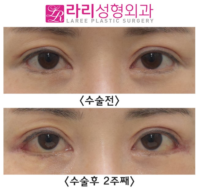 [라리성형외과] 뒤트임수술 단기경과, 결막부종 없이 회복이 빠 경우도 있어요. 관련 이미지 1