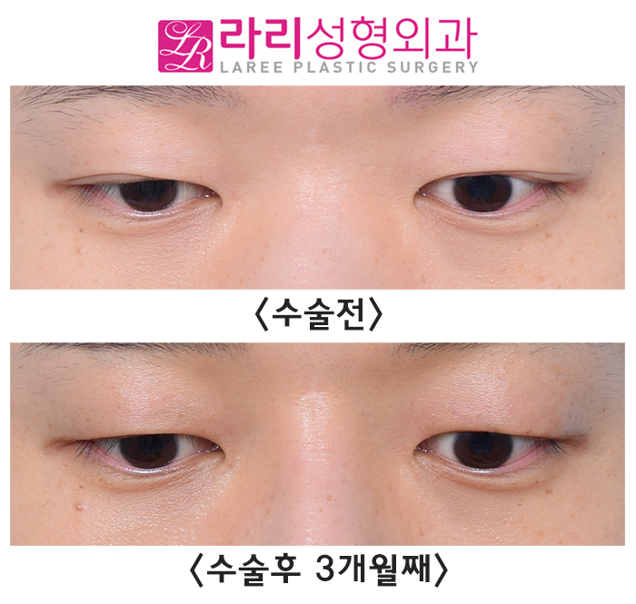 [라리성형외과] 고르지 못한 쌍꺼풀 라인의 개선을 위한 쌍꺼풀 지우는 수술 전후 사진 관련 이미지 3