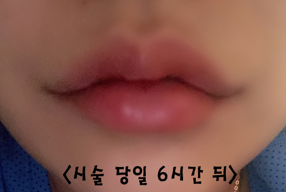 How to Make the Corners of the Mouth Lift Beautifully with Lip Corner Filler image 9