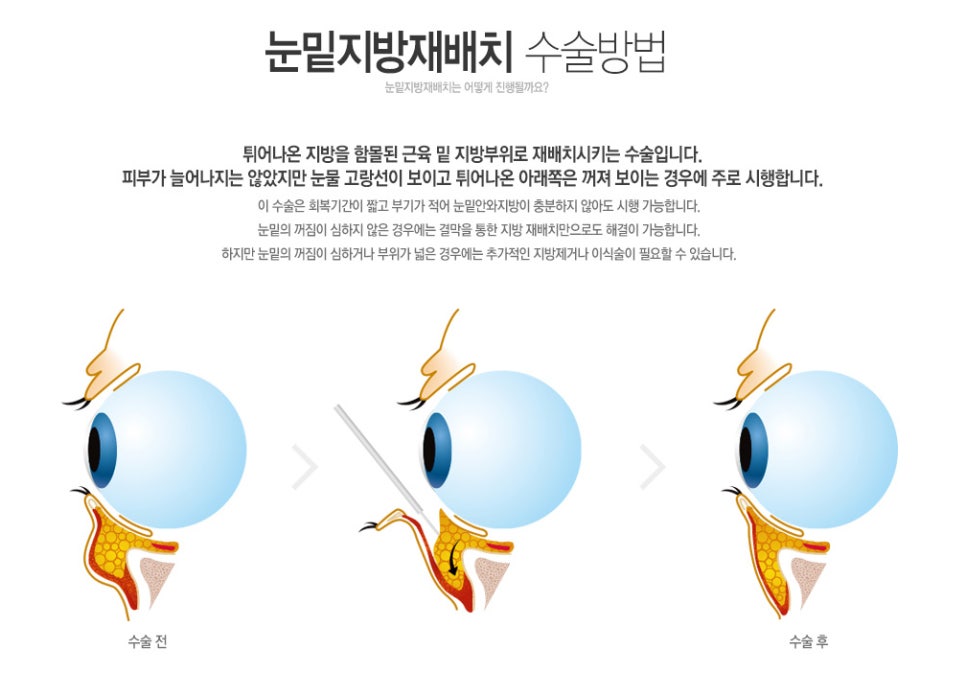 눈수술종류 뭐가 있나요? 관련 이미지 8