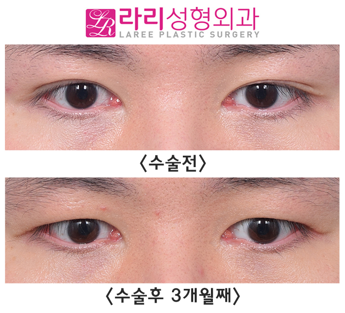 [라리성형외과] 쌍수 흉터까지 없애는 쌍꺼풀없애기수술 전후 사진 보기 관련 이미지 2