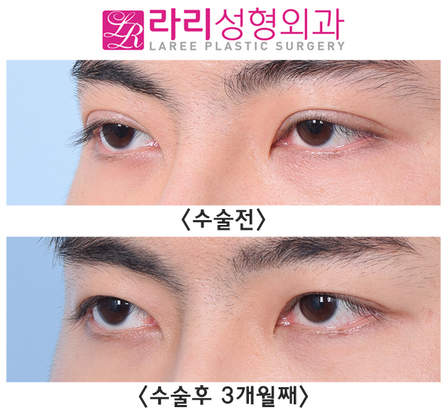 [라리성형외과] 일타쌍피, 한 번의 수술로 쌍꺼풀없애는수술과 눈매교정을 동시에 관련 이미지 2