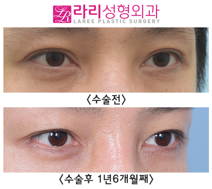 [라리성형외과] 쌍꺼풀없애기 ? 쌍꺼풀라인낮추기 ? 고민이 된다면 관련 이미지 4