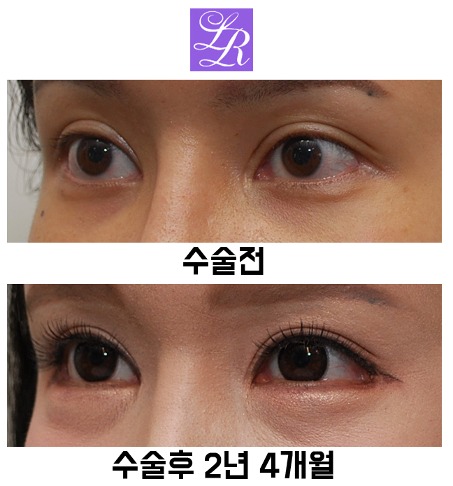 Postoperative Adhesion After Lateral Canthoplasty - The Effect of Revision Lateral Canthoplasty to Lower the Outer Eye Corner image 3