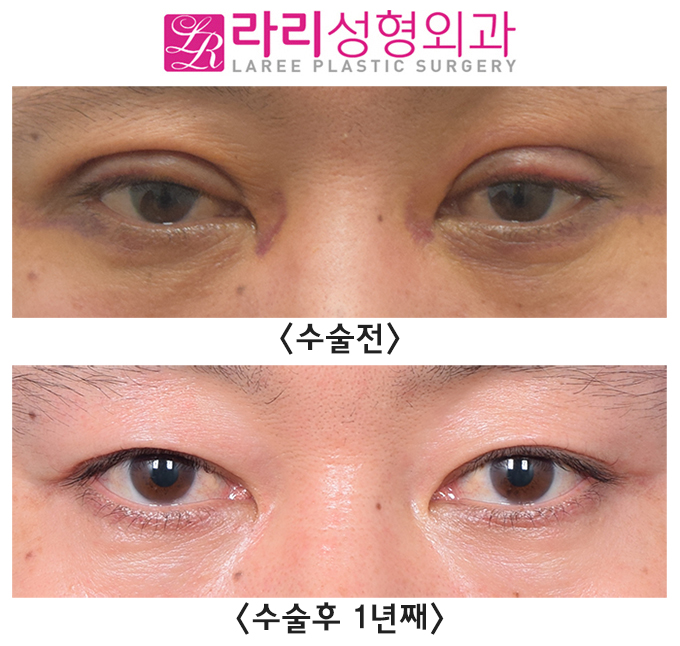 [라리성형외과] 급속교정 쌍꺼풀재수술 필요한 눈, 가능한 관련 이미지 1