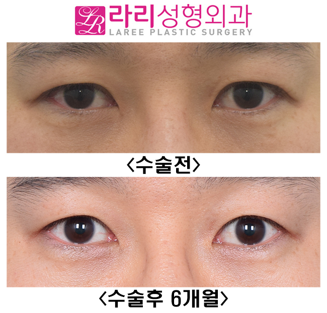 [라리성형외과] 눈을 떠도 눈을 감아도 쌍꺼풀이 없는 쌍꺼풀없애기 관련 이미지 1