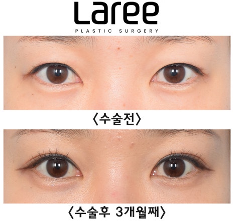 [Lari Plastic Surgery] A Collection of Various Surgeries for Double Eyelids image 3