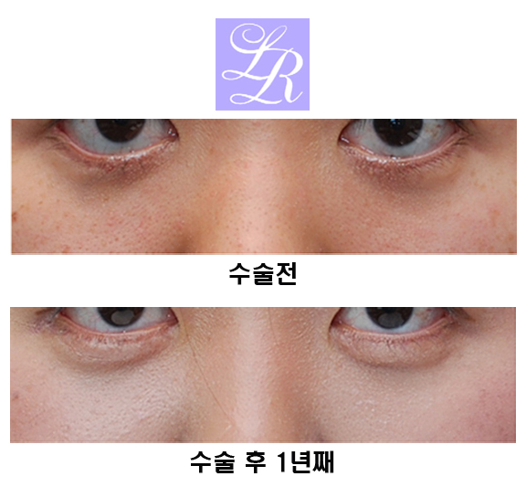 하안검수술,잘 알고 시행해야 관련 이미지 4