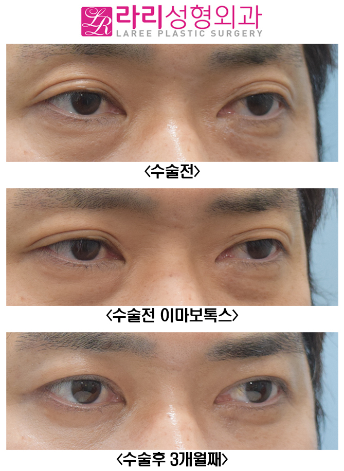 [라리성형외과] 여러겹 쌍꺼풀 제거 관련 이미지 3